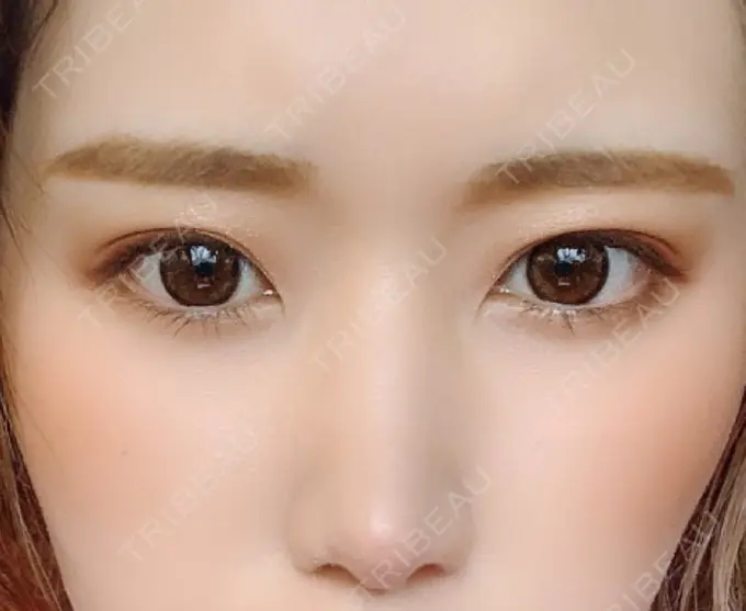 二重埋没 湘南美容クリニック 金沢院 AFTER メイン用