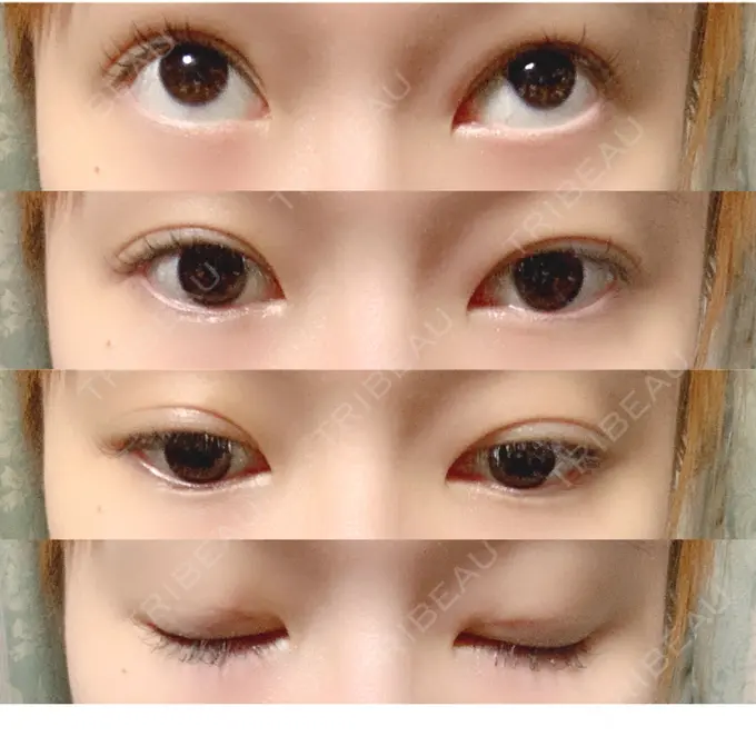 二重埋没 共立美容外科 柏院 DAY 3 メイン用