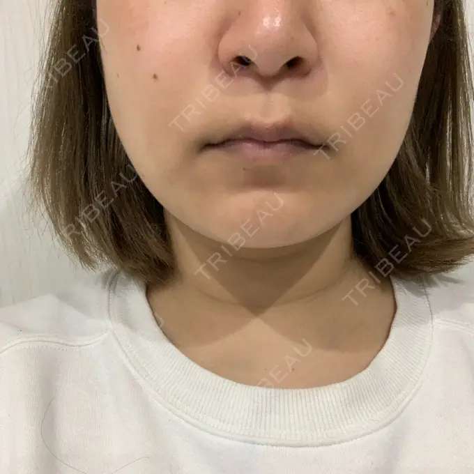 糸リフト / 脂肪溶解注射（顔） 品川スキンクリニック 新潟院 AFTER メイン用