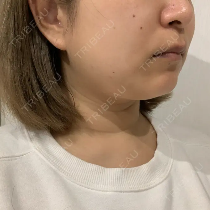 糸リフト / 脂肪溶解注射（顔） 品川スキンクリニック 新潟院 DAY 90 メイン用