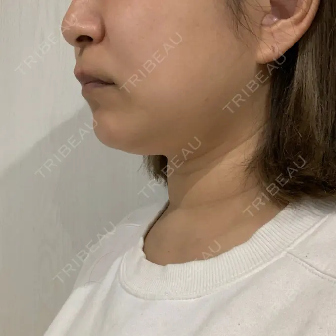 糸リフト / 脂肪溶解注射（顔） 品川スキンクリニック 新潟院 DAY 90 メイン用