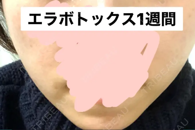 ボトックス（エラ・小顔） 湘南美容クリニック 新橋銀座口院 AFTER メイン用