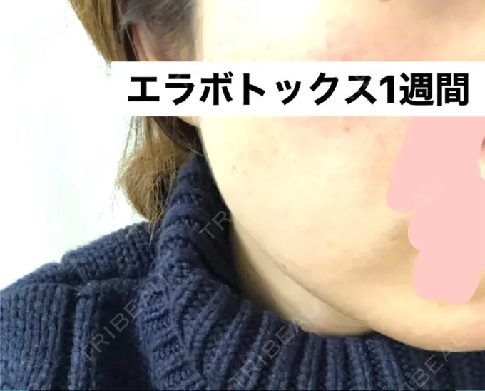 ボトックス（エラ・小顔） 湘南美容クリニック 新橋銀座口院 DAY 7 メイン用