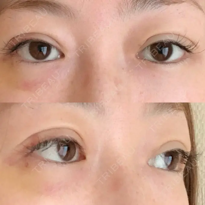 二重埋没 / 眼瞼下垂（切開） BIANCA表参道 DAY 7 メイン用