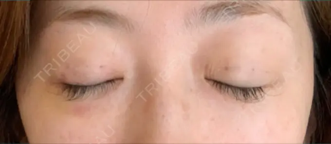 二重埋没 / 眼瞼下垂（切開） BIANCA表参道 DAY 7 メイン用