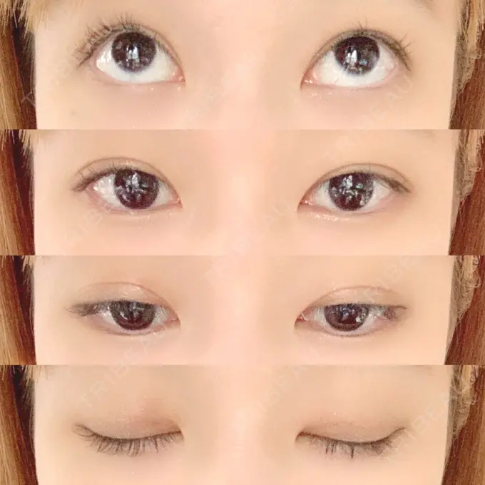 二重埋没 共立美容外科 柏院 DAY 4 メイン用