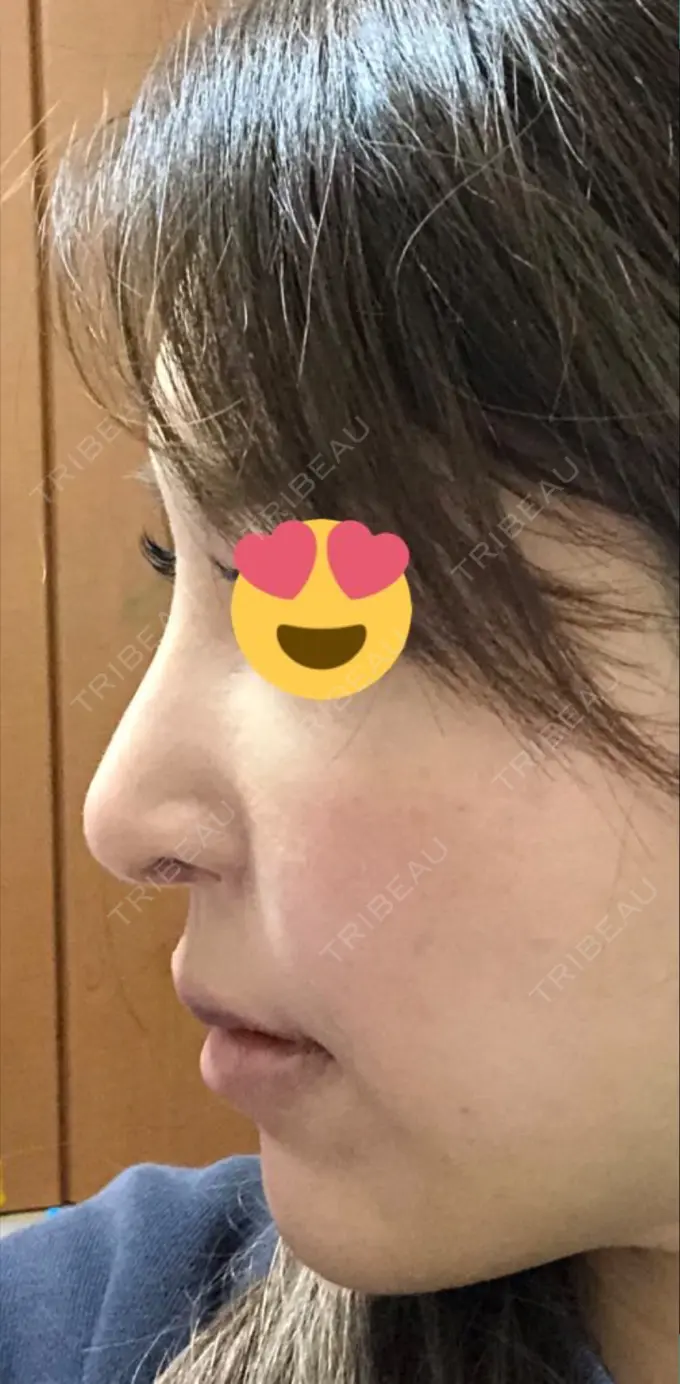 隆鼻術 / 鼻中隔延長（切開） / 軟骨移植 / 骨切幅寄せ / プロテーゼ除去 / 鼻修正 / 真皮移植 / 鼻孔縁下降 KOKO整形外科 DAY 95 メイン用