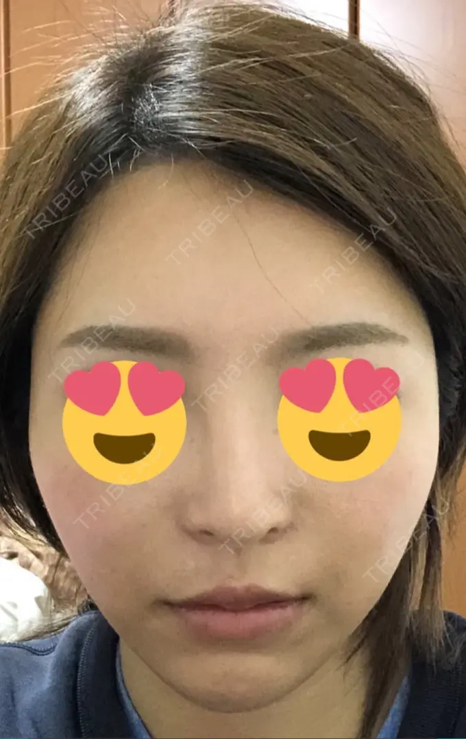 隆鼻術 / 鼻中隔延長（切開） / 軟骨移植 / 骨切幅寄せ / プロテーゼ除去 / 鼻修正 / 真皮移植 / 鼻孔縁下降 KOKO整形外科 DAY 95 メイン用