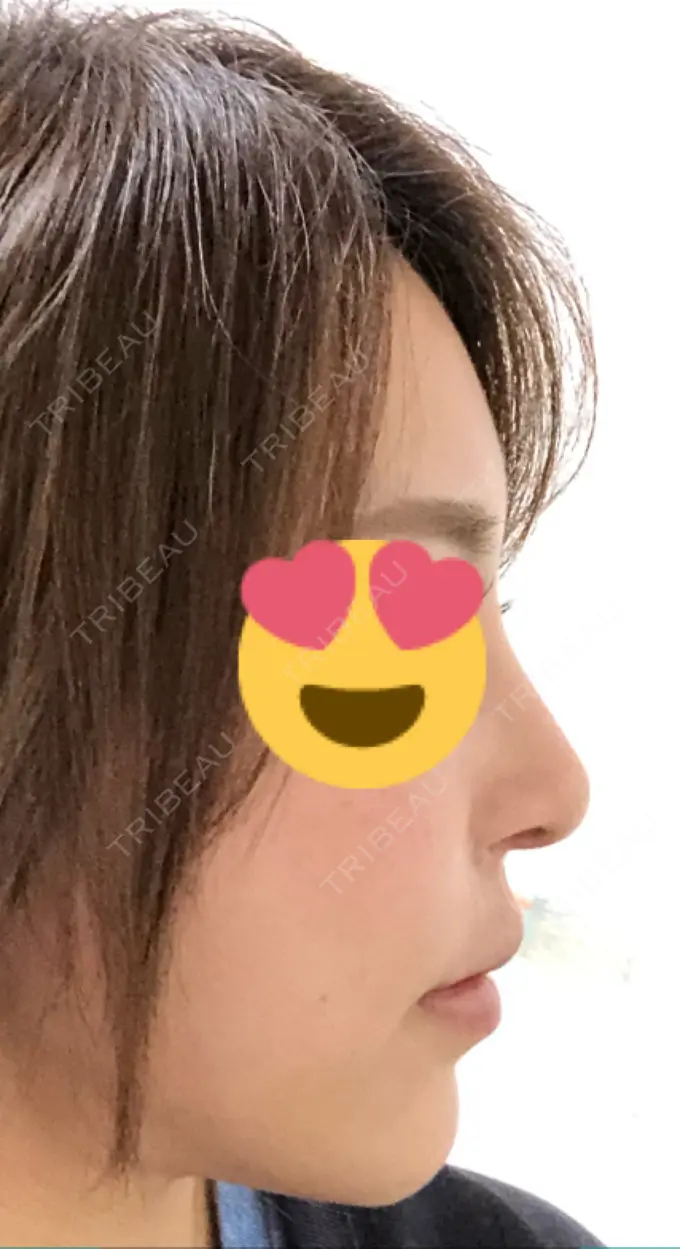 隆鼻術 / 鼻中隔延長（切開） / 軟骨移植 / 骨切幅寄せ / プロテーゼ除去 / 鼻修正 / 真皮移植 / 鼻孔縁下降 KOKO整形外科 DAY 95 メイン用