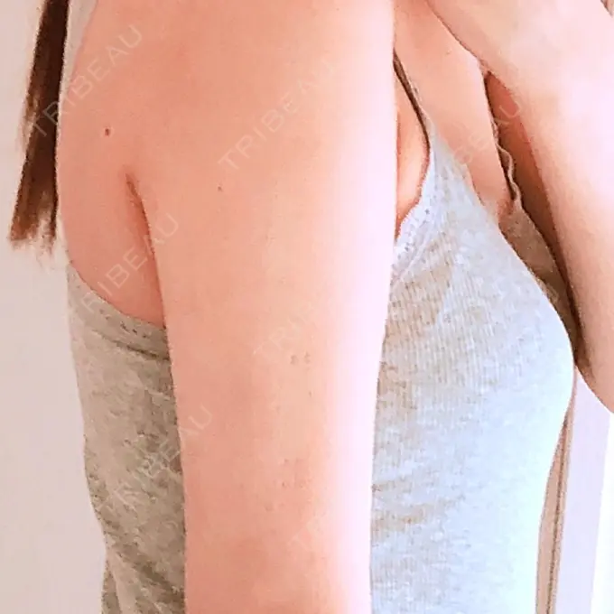 脂肪吸引（二の腕） 湘南メディカル記念病院（両国） DAY 65 メイン用