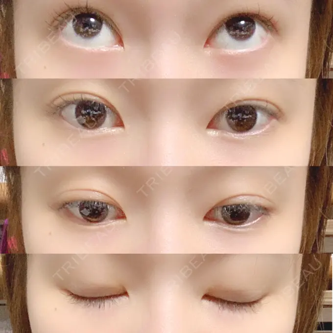 二重埋没 共立美容外科 柏院 DAY 6 メイン用