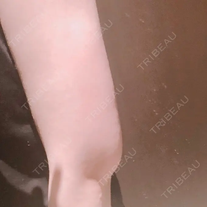 脂肪吸引（二の腕） 湘南メディカル記念病院（両国） DAY 39 メイン用