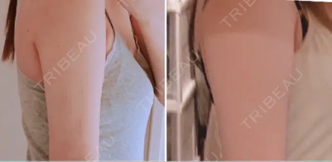 脂肪吸引（二の腕） 湘南メディカル記念病院（両国） AFTER メイン用