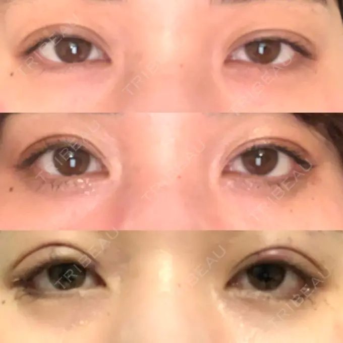 眼瞼下垂（切開） / 目尻切開 / タレ目形成・グラマラスライン（切開） プロミス整形外科 DAY 36 メイン用
