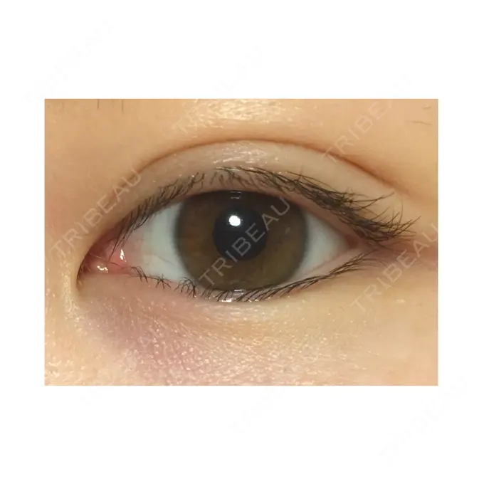 二重埋没 城本クリニック 福岡院 AFTER メイン用