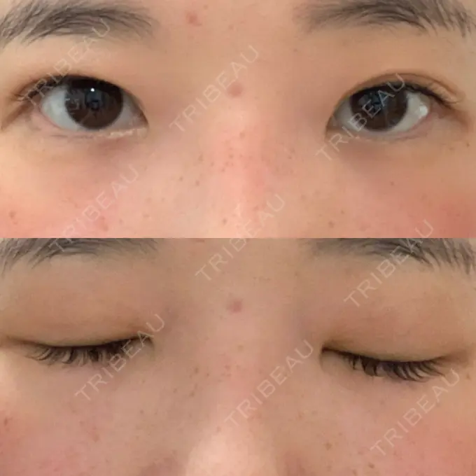 二重埋没 湘南美容クリニック 東京蒲田院 DAY 63 メイン用