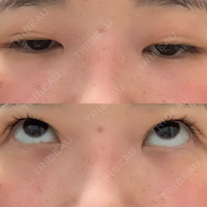 二重埋没 湘南美容クリニック 東京蒲田院 DAY 63 メイン用