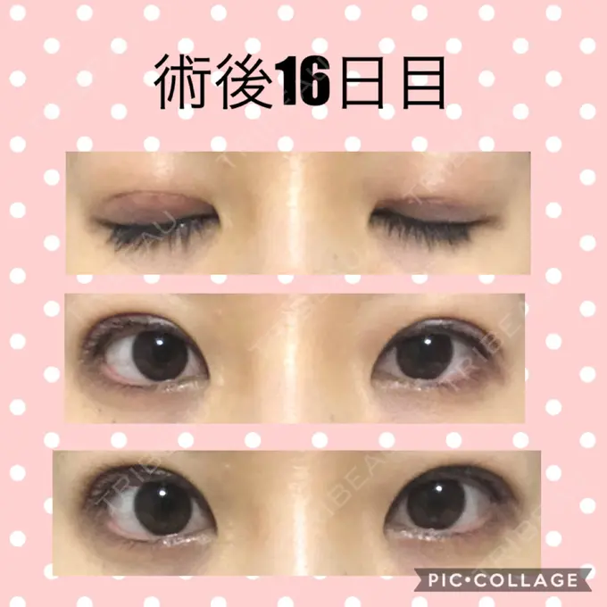 二重切開 マリアクリニック 安城院 DAY 16 メイン用