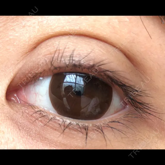 二重埋没 かわた美容クリニック DAY 7 メイン用