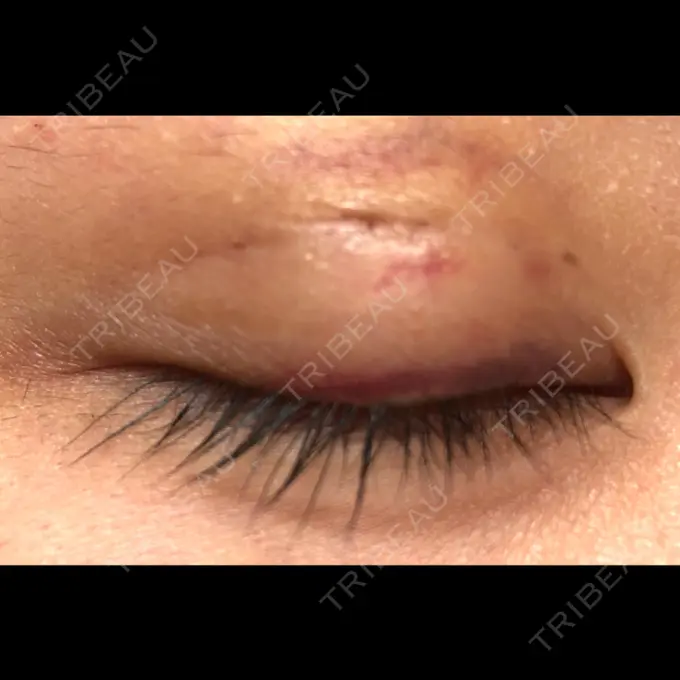 二重埋没 かわた美容クリニック DAY 7 メイン用