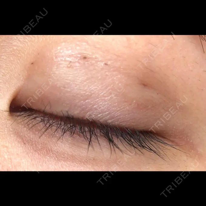 二重埋没 かわた美容クリニック DAY 7 メイン用