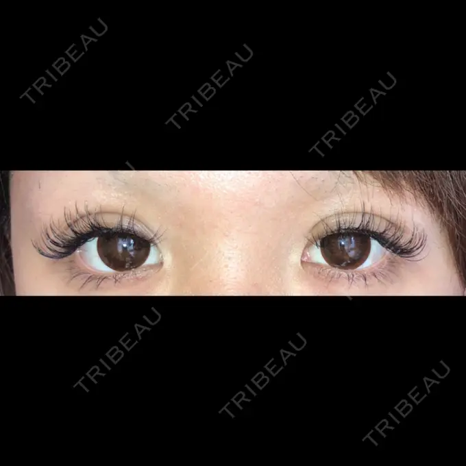 二重埋没 かわた美容クリニック DAY 14 メイン用