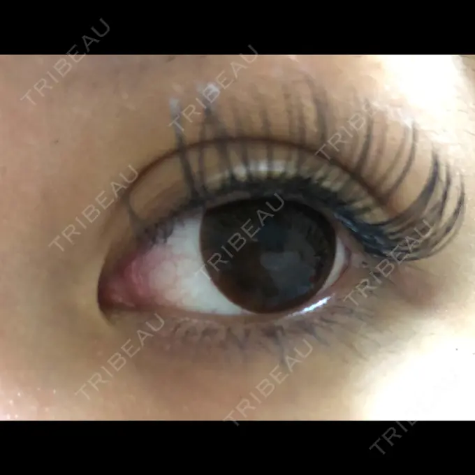 二重埋没 かわた美容クリニック AFTER メイン用