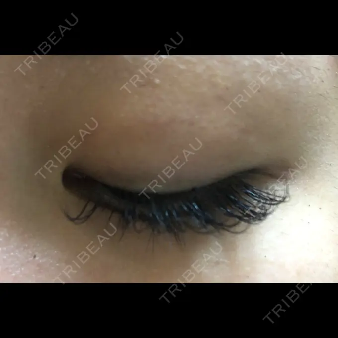 二重埋没 かわた美容クリニック DAY 21 メイン用