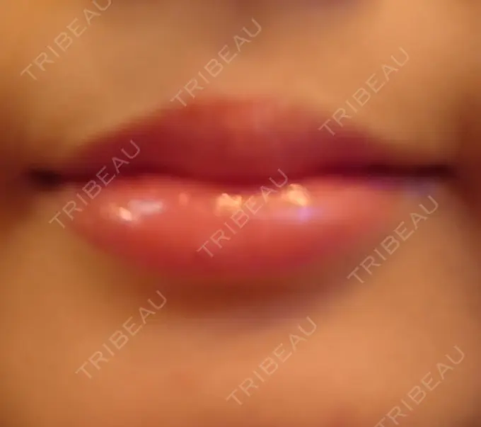 口角挙上 / その他（口元） 現代美学整形外科 AFTER メイン用