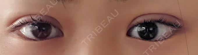 二重埋没 城本クリニック 名古屋院 DAY 1 メイン用