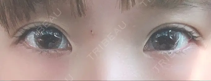 二重埋没 湘南美容クリニック 札幌院 DAY 27 メイン用