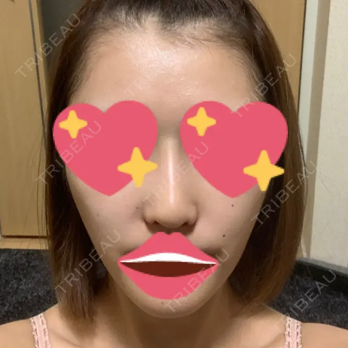 隆鼻術 / 鼻尖形成（切開） / 小鼻縮小（切開） / ボトックス（エラ・小顔） / その他（鼻） ルラ美容クリニック 高田馬場院 DAY 25 メイン用