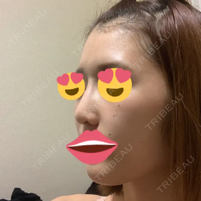 隆鼻術 / 鼻尖形成（切開） / 小鼻縮小（切開） / ボトックス（エラ・小顔） / その他（鼻） ルラ美容クリニック 高田馬場院 DAY 25 メイン用