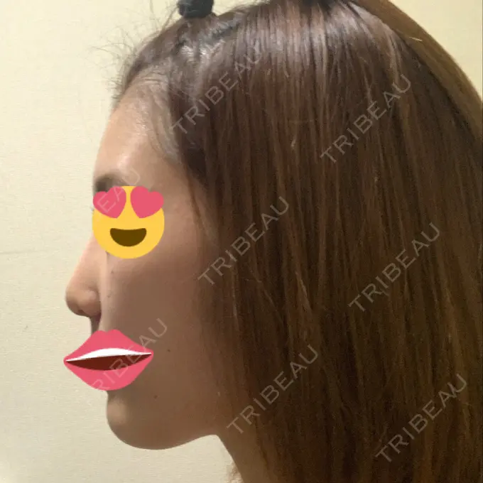 隆鼻術 / 鼻尖形成（切開） / 小鼻縮小（切開） / ボトックス（エラ・小顔） / その他（鼻） ルラ美容クリニック 高田馬場院 DAY 25 メイン用