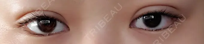 二重埋没 城本クリニック 名古屋院 DAY 2 メイン用