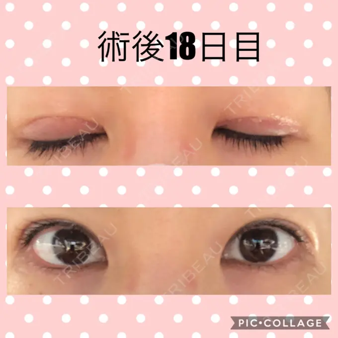 二重切開 マリアクリニック 安城院 DAY 18 メイン用