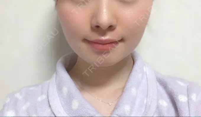 脂肪溶解注射（顔） 赤坂プレミアクリニック DAY 12 メイン用