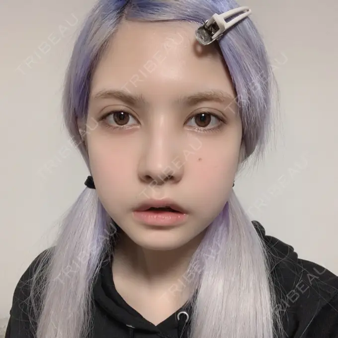 ガミースマイル手術 / セットバック / ルフォー+ssro（両あご) / 輪郭修正 / 矯正（ワイヤー） クラインデンタルクリニック DAY 24 メイン用