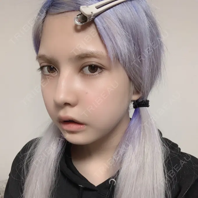 ガミースマイル手術 / セットバック / ルフォー+ssro（両あご) / 輪郭修正 / 矯正（ワイヤー） クラインデンタルクリニック DAY 24 メイン用