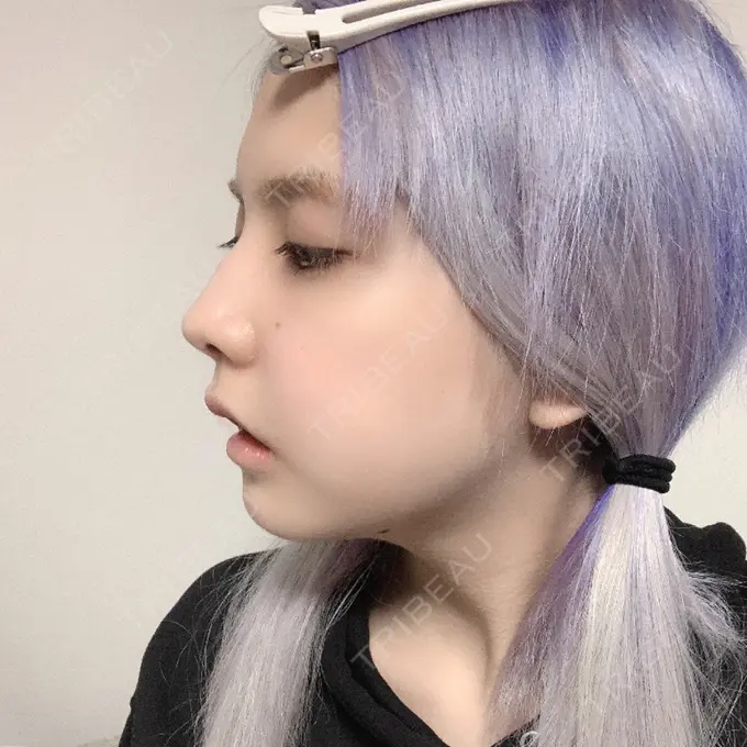 ガミースマイル手術 / セットバック / ルフォー+ssro（両あご) / 輪郭修正 / 矯正（ワイヤー） クラインデンタルクリニック DAY 24 メイン用