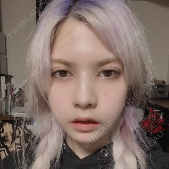 ガミースマイル手術 / セットバック / ルフォー+ssro（両あご) / 輪郭修正 / 矯正（ワイヤー） クラインデンタルクリニック DAY 27 メイン用