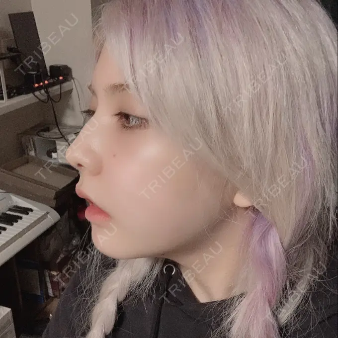 ガミースマイル手術 / セットバック / ルフォー+ssro（両あご) / 輪郭修正 / 矯正（ワイヤー） クラインデンタルクリニック DAY 27 メイン用