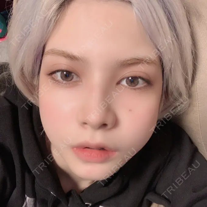 ガミースマイル手術 / セットバック / ルフォー+ssro（両あご) / 輪郭修正 / 矯正（ワイヤー） クラインデンタルクリニック DAY 39 メイン用