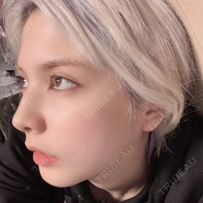 ガミースマイル手術 / セットバック / ルフォー+ssro（両あご) / 輪郭修正 / 矯正（ワイヤー） クラインデンタルクリニック DAY 39 メイン用