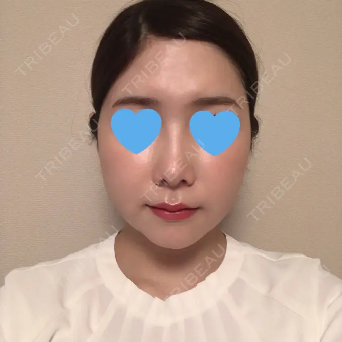 糸リフト / 骨切り（あご） / 骨削り（頬） / 脂肪吸引（顔） RG整形外科（旧リオン整形外科） DAY 29 メイン用