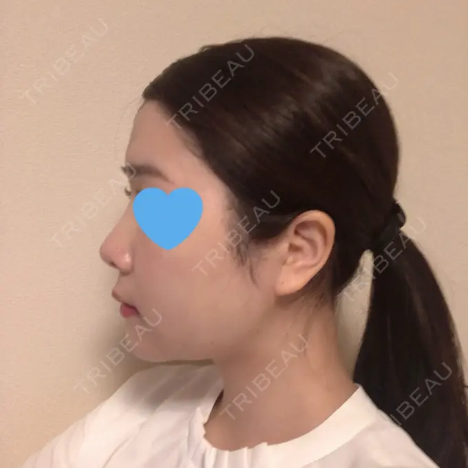 糸リフト / 骨切り（あご） / 骨削り（頬） / 脂肪吸引（顔） RG整形外科（旧リオン整形外科） DAY 29 メイン用