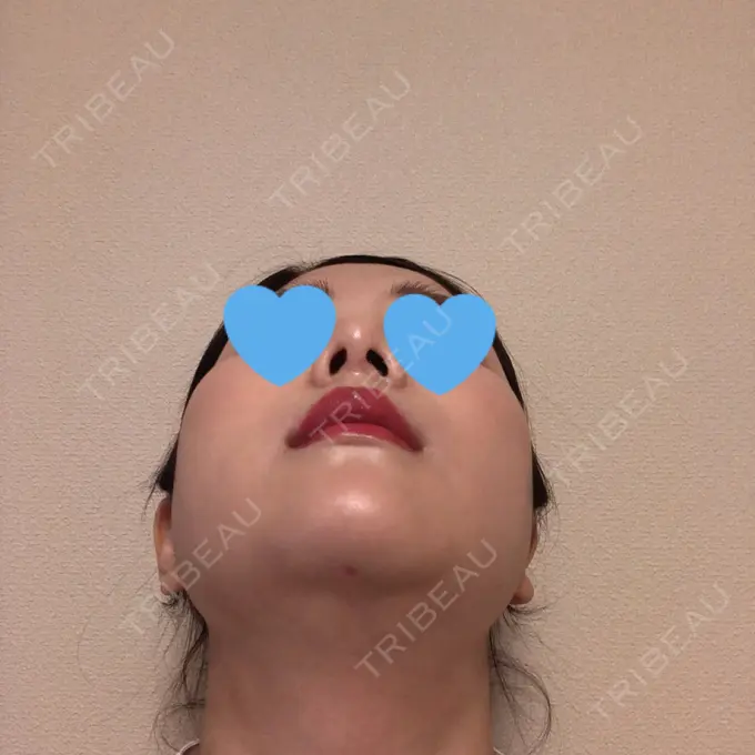 糸リフト / 骨切り（あご） / 骨削り（頬） / 脂肪吸引（顔） RG整形外科（旧リオン整形外科） DAY 29 メイン用