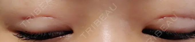 二重埋没 城本クリニック 名古屋院 DAY 3 メイン用