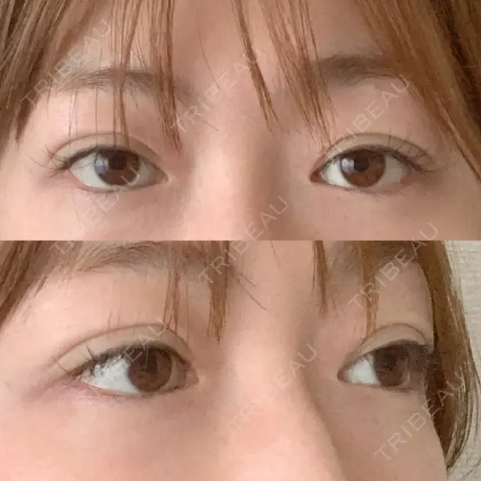 二重埋没 / 眼瞼下垂（切開） BIANCA表参道 AFTER メイン用