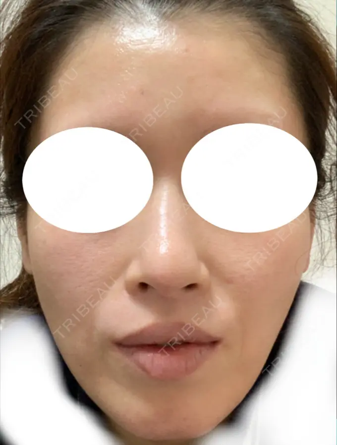 鼻尖形成（切開） / 鼻中隔延長（切開） / 軟骨移植 / 鼻尖縮小 エートップ美容整形外科 AFTER メイン用